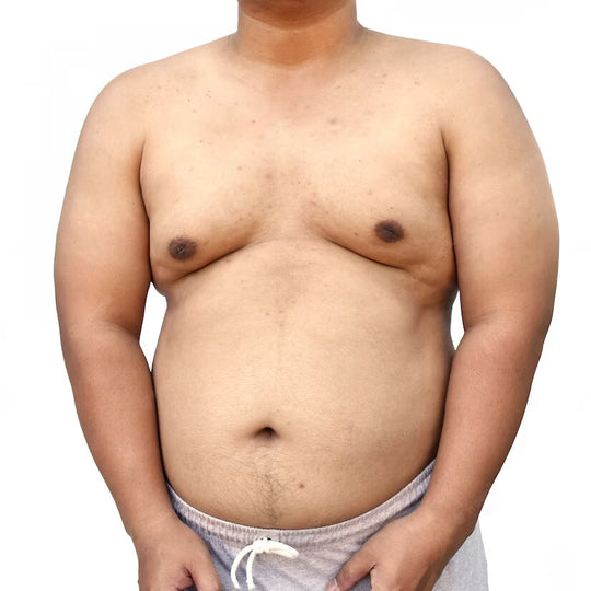 The Truth About Gynecomastia: Will It Go Away on Its Own?